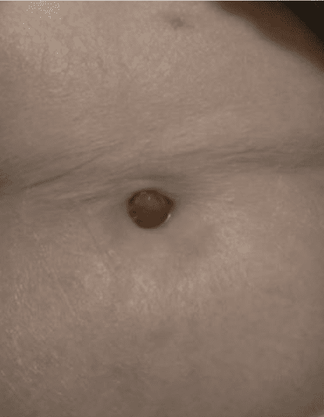 Gros plan sur un nombril, en photo médicale.