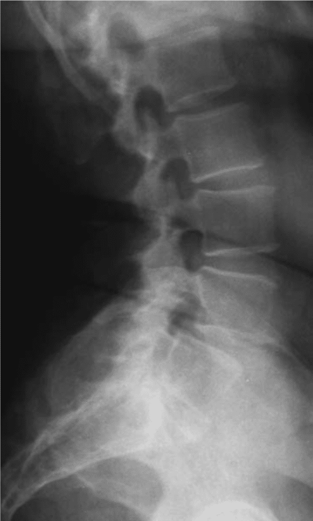 Radiographie de la colonne vertébrale, vue de face.