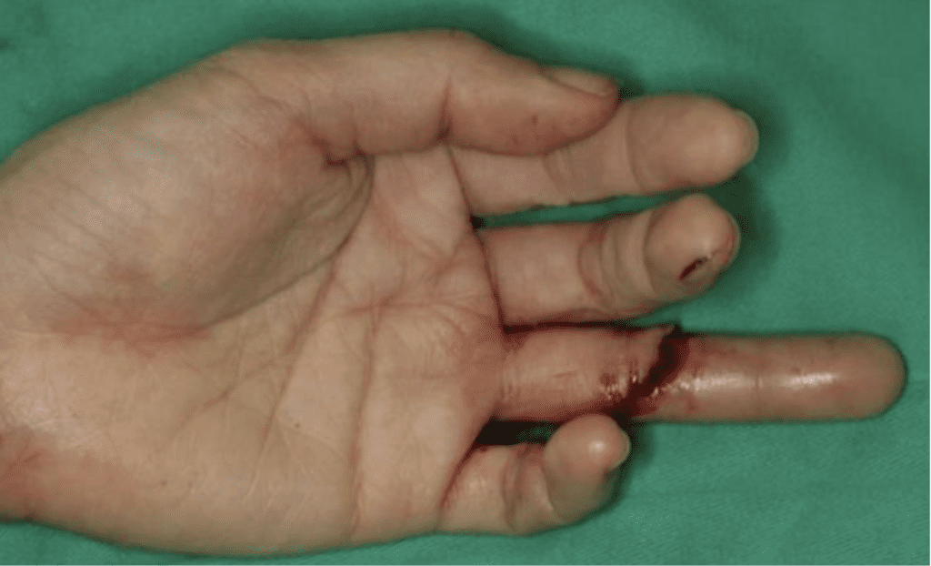 Gros plan sur la main d’un patient, en contexte médical.